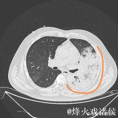 埃迪-豪：得肺炎住院后，意识到医疗体系与医护人员至关重要